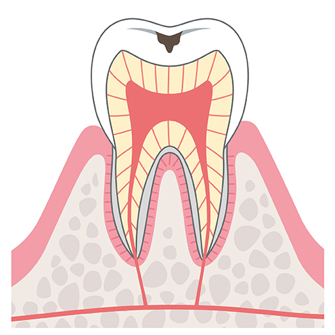 C1エナメル質までのむし歯