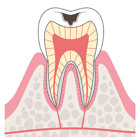C2象牙質まで到達したむし歯