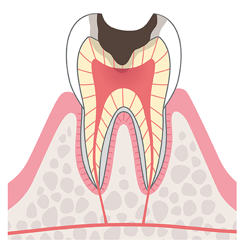 C3歯髄まで到達したむし歯