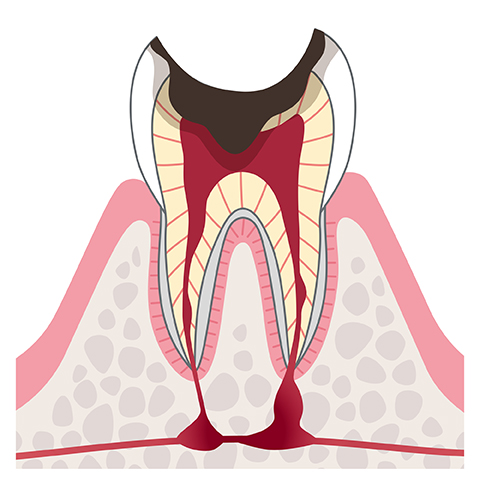 C4歯の根っこだけが残った状態のむし歯