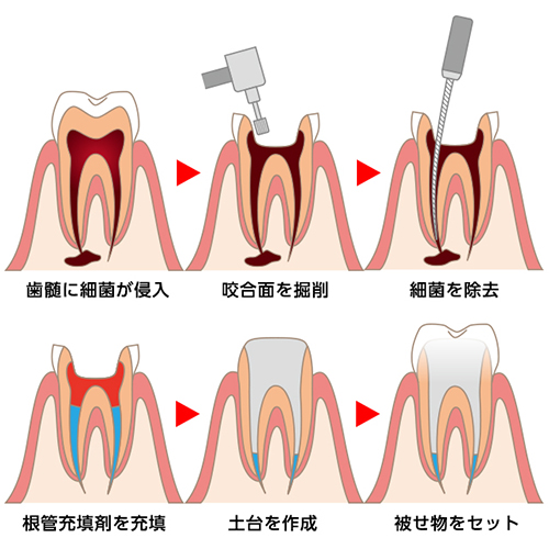 根管治療とは